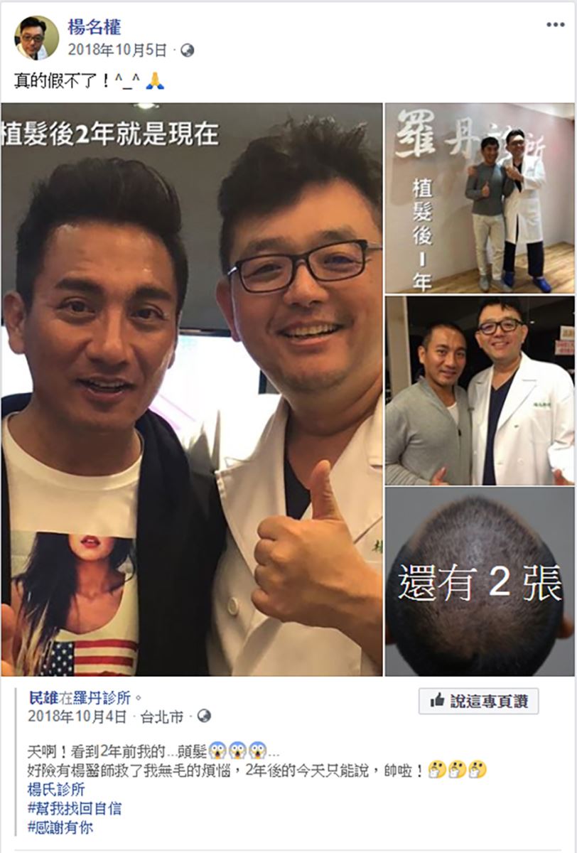 植髮,生髮613 禿髮,楊氏羅丹,雄性禿,禿頭